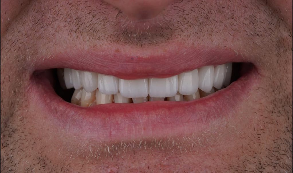 ฟันห่าง