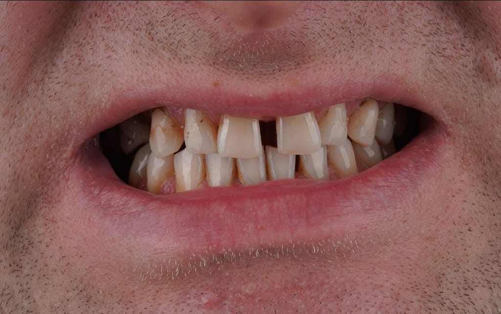 ฟันห่าง