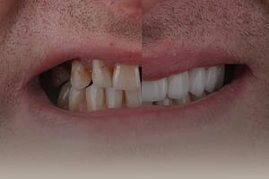 ฟันห่าง