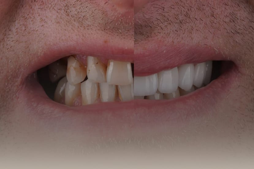 ฟันห่าง